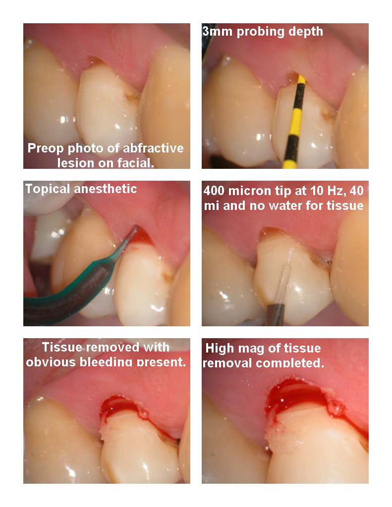 Class V with bleeding pg 1.jpg